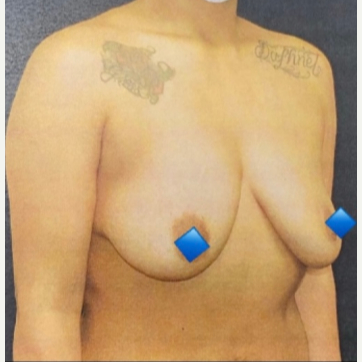 Breast Lift with Implants - Before 0