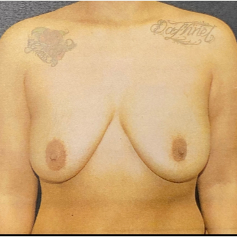 Breast Lift with Implants - Before 1