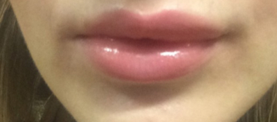 Dermal Fillers - After