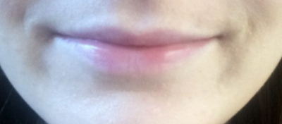 Dermal Fillers - Before