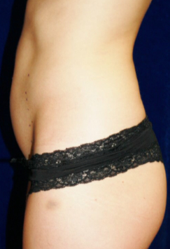 Laser Liposuction - Before 0