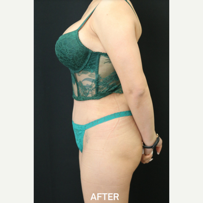 Tummy Tuck - After 1