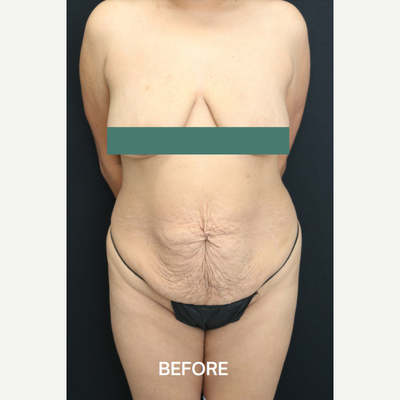 Tummy Tuck - Before