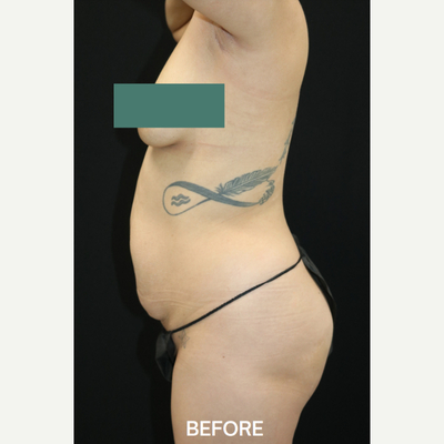 Tummy Tuck - Before 1