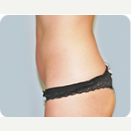 Vaser Liposuction - After