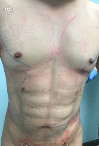 Vaser Liposuction - After 4